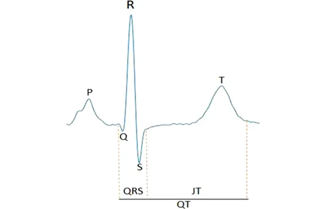 Annotation of an example ECG signal