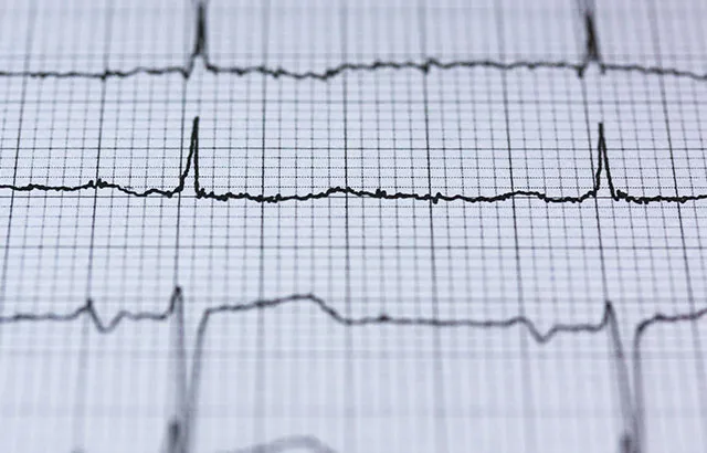 Electrocardiodiagram