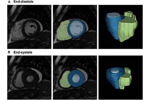 Risk factors for heart disease change heart structure and appearance