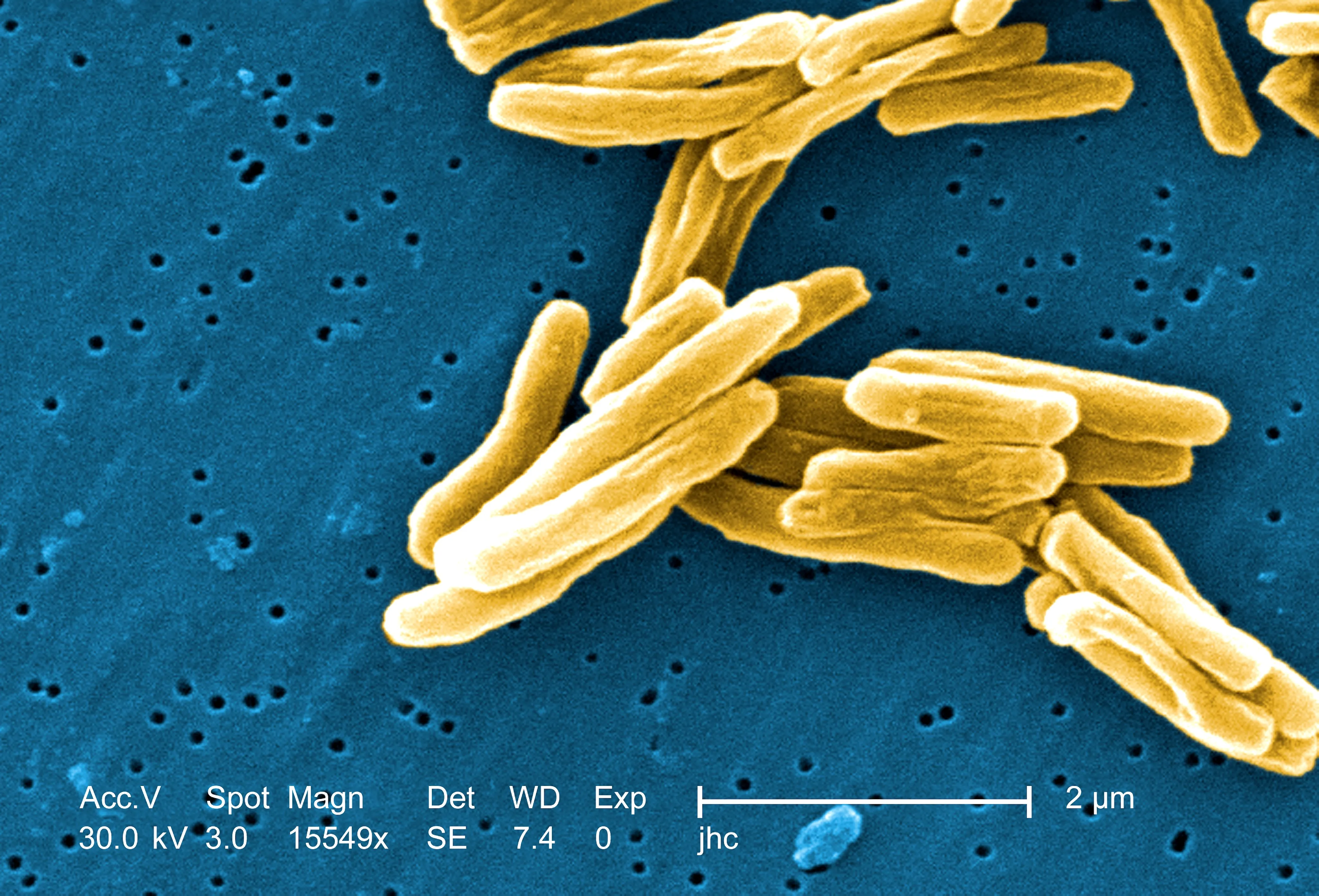 tuberculosis