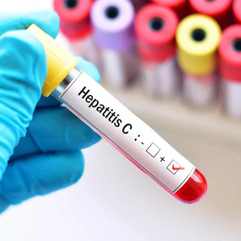 Hepatitis C