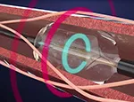 Renal denervation system