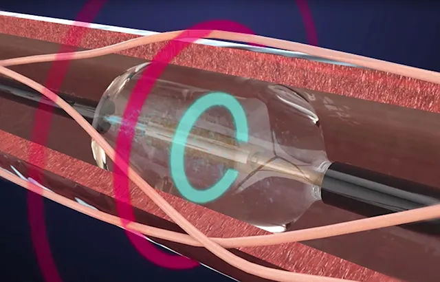 Renal denervation system