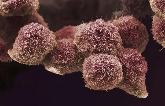 Pancreatic cancer cells grown in culture, SEM. Credit: Anne Weston, Francis Crick Institute. Attribution-NonCommercial 4.0 International (CC BY-NC 4.0)