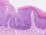 Microscope image of abnormal cells within the anus