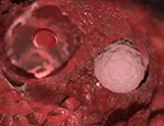 Metastasis - Invasion of cancer in the bloodstream
