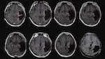 MRI brain scans of one of the trial participants who achieved a complete response. See original paper for more details. © Ning, W. et al. 2024 CC-BY 4.0