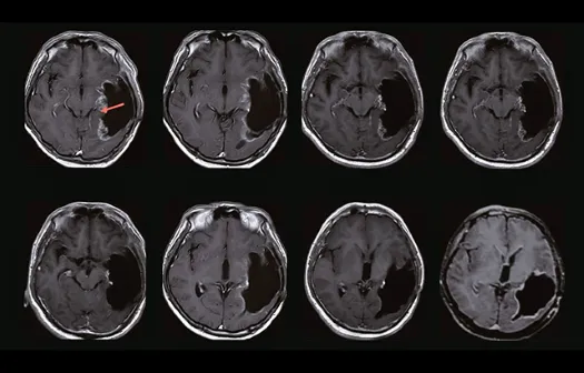 Understanding glioblastoma development 