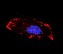 A cancer cell which has taken up microparticles developed by BioMoti