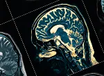MRI Scan. Credit:iStock.com