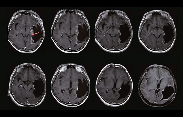 MRI brain scans of one of the trial participants who achieved a complete response. See original paper for more details. © Ning, W. et al. 2024 CC-BY 4.0