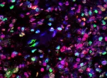 Glioblastoma under microscope with dyes.