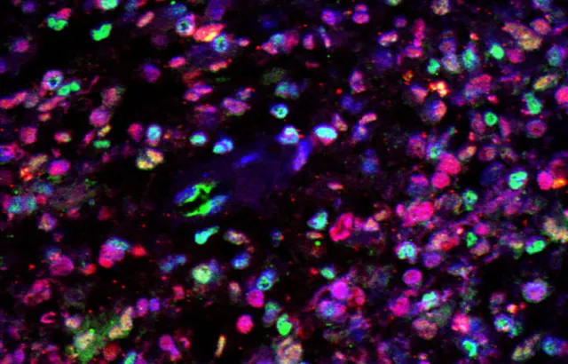 Glioblastoma under microscope with dyes. Credit: Brain Tumour Research Centre of Excellence at Queen Mary University of London