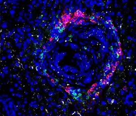 Pancreatic cancer cells being infiltrated by immune cells