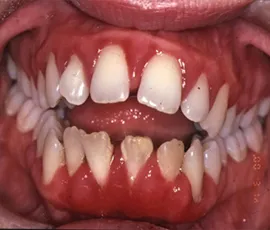 Gum disease leads to painful gums and the loosening of teeth