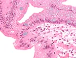 High-magnification micrograph of Barrett's oesophagus 