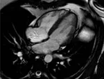An MRI scan of the heart