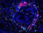 Pancreatic cancer cells being infiltrated by immune cells