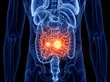 3d rendered medically accurate illustration of small intestine cancer By Sebastian Kaulitzki3d rendered medically accurate illustration of small intestine cancer By Sebastian Kaulitzki