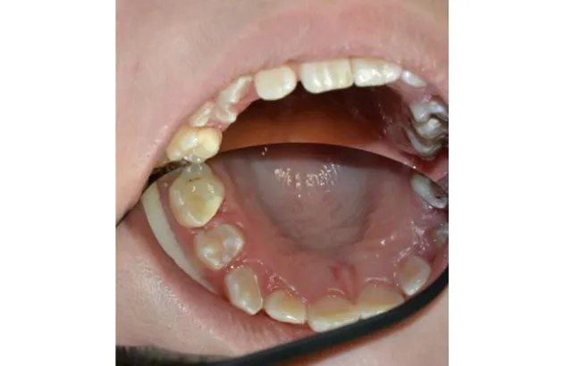 Image of glass cement fillings, copyright Semmelweis University Dental School