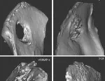 Bone formation around an implant