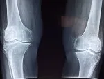 Knee x-ray. Image by Dr. Manuel González Reyesa from pixabay