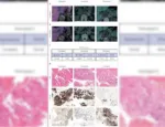 Molecular Imaging of the Adrenal Glands in 3 Patients.