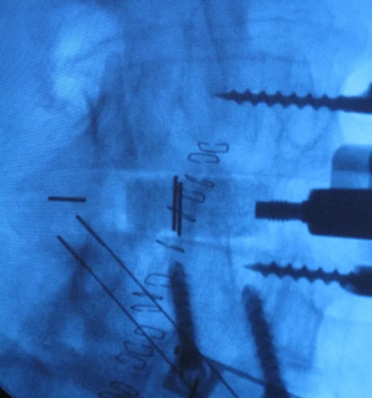Inductigraft™ X-ray image
